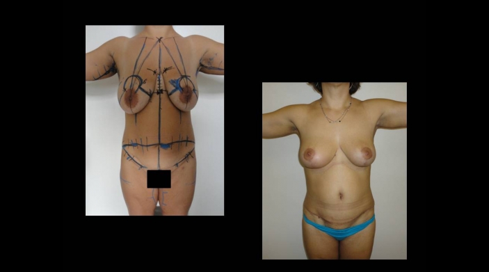 Mellfelvarrás-hónalj-karplasztikával, hasplasztika és complasztika : body sculpturing (testszobrászat)