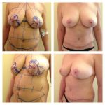 Body contouring: Mellkisebbítés, hasplasztika, zsírleszívás