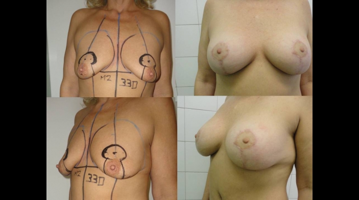 Breast lift