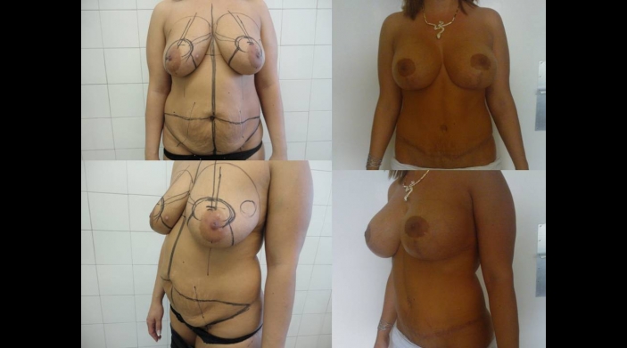 Combined tummy tuck and breast surgery