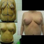 Combined tummy tuck and breast surgery