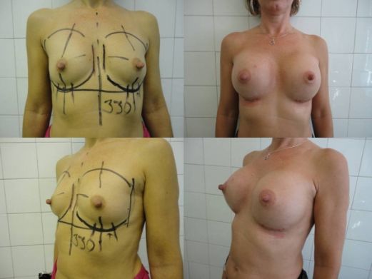 Breast augmentation