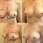 Breast augmentation