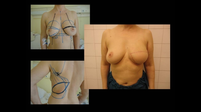 Reconstructive breast surgery