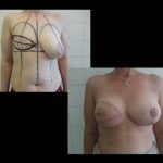 Reconstructive breast surgery
