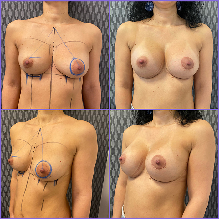 Breast augmentation with asymmetry correction